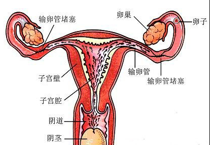 输卵管不通示意图